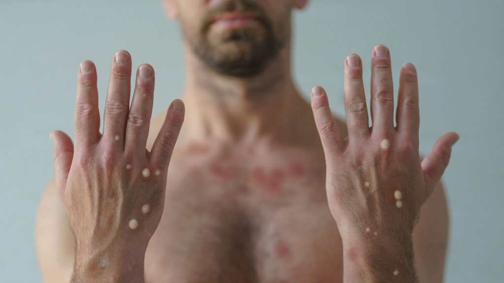 Prevenção e Controle da Monkeypox nos serviços de Saúde - Grupo IBES